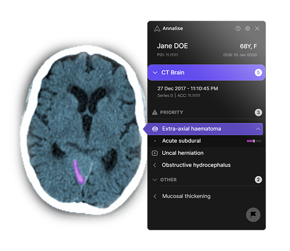An image of a CT brain scan with an Annalise bubble of text listing generic information.